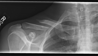 clavicle1.jpg