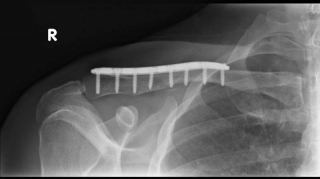 clavicle2.jpg