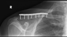 clavicle2.jpg